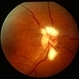 Myelinated Nerve Fiber Layer